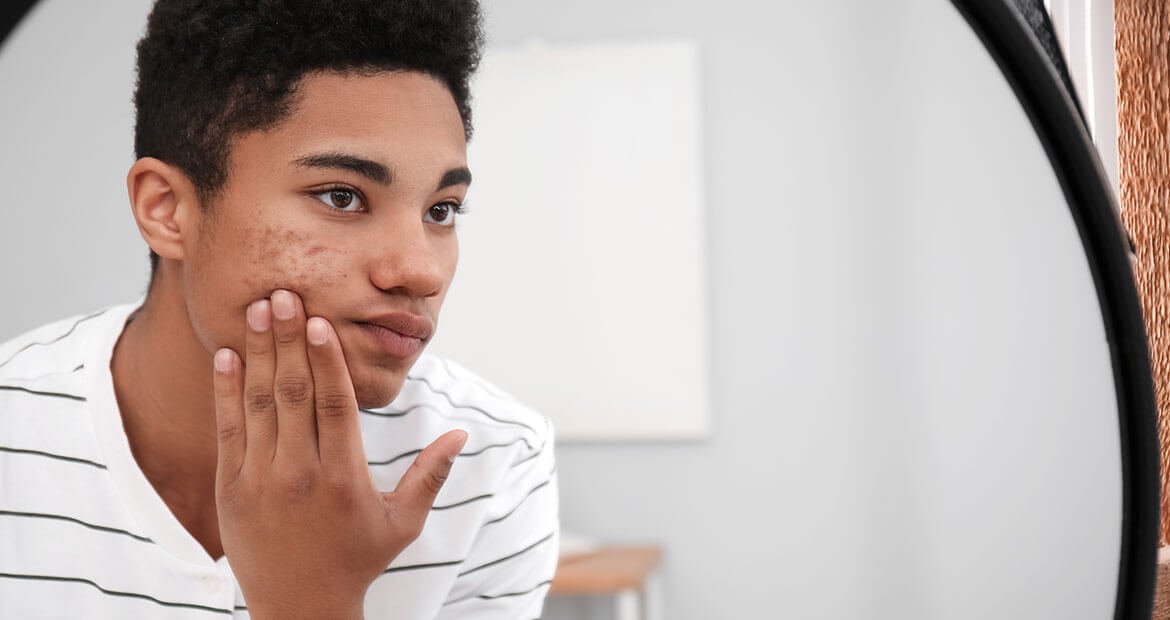 Saiba como tratar manchas e cicatrizes de acne | L'Oréal Paris